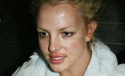 Britney Spears Restylane injections